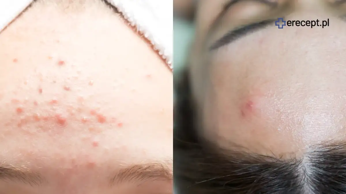 Pryszcze na szyi? Poznaj ukryte przyczyny i odzyskaj gładką cerę