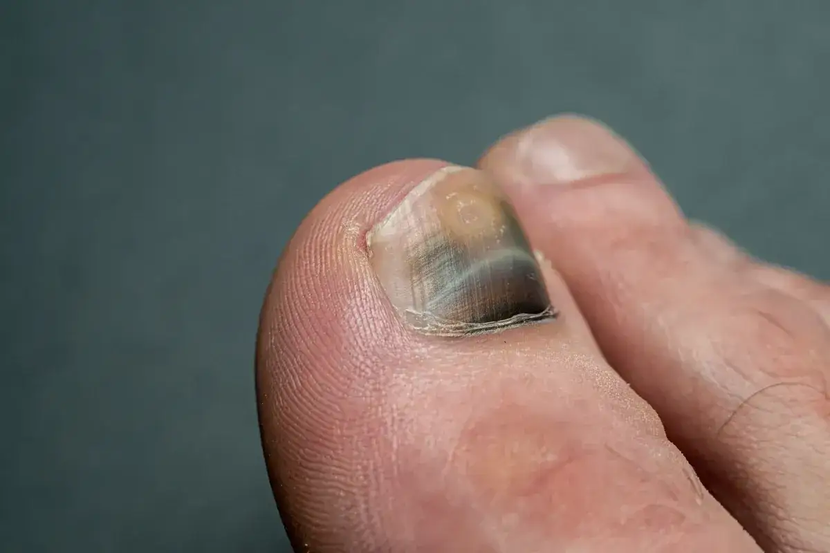 Czerniak paznokcia: objawy, różnicowanie. Kiedy do lekarza?