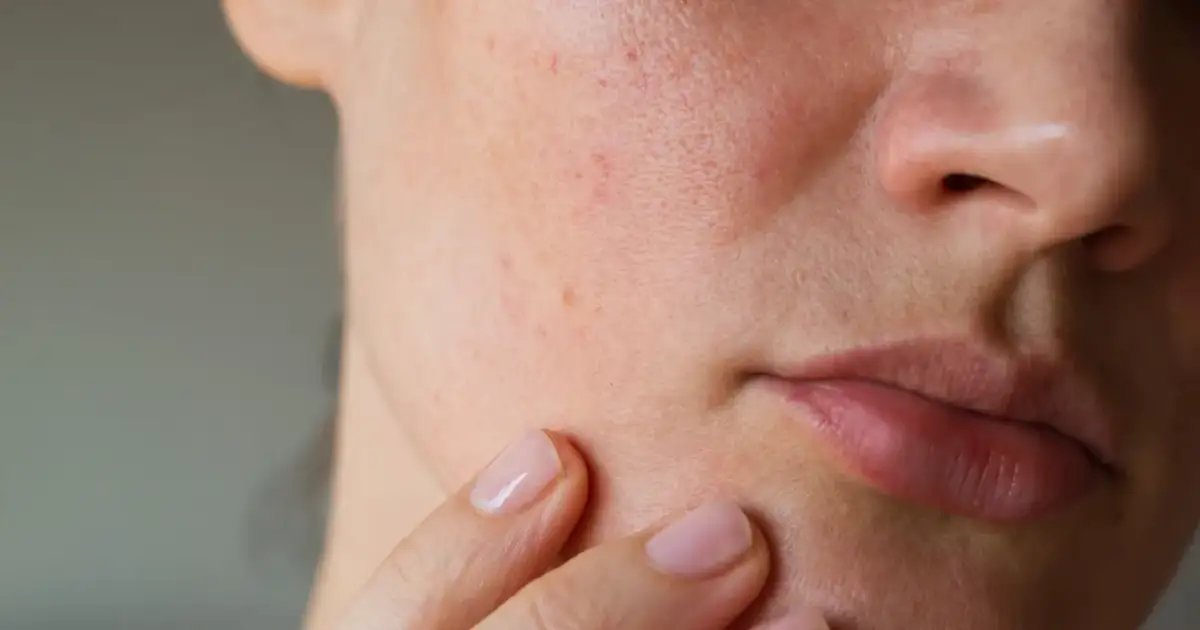 Zbliżenie na skórę twarzy z widocznymi niedoskonałościami i zaczerwienieniami, palec wskazujący dotyka policzka.