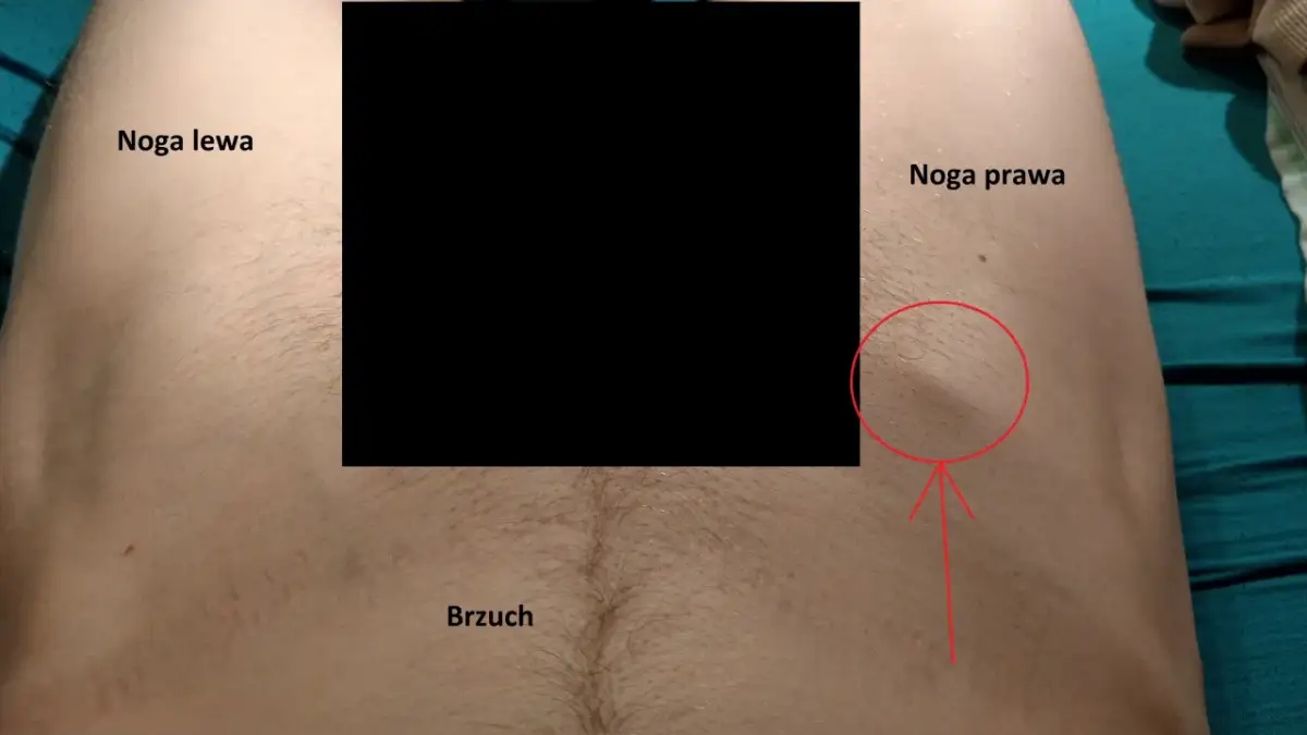 Powiększone węzły chłonne pachwinowe: Do lekarza rodzinnego! Co dalej?