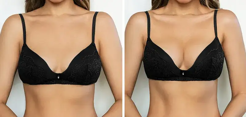 Powiększanie biustu - gdzie najtaniej i bezpiecznie? Porównanie cen