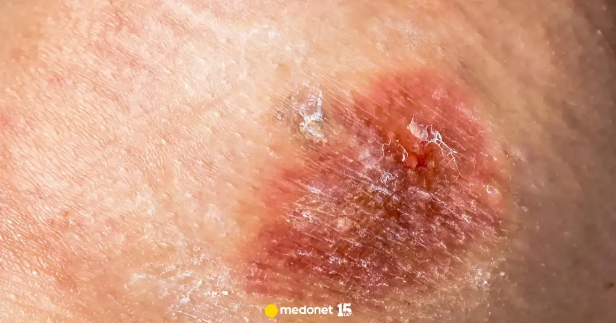 Kwas z akumulatora na skórze? Ratuj zdrowie! Pierwsza pomoc