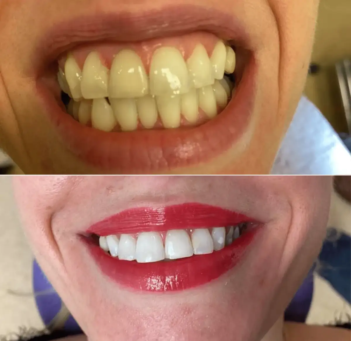 Wybielanie zębów u dentysty: Koszt, efekty i bezpieczeństwo. Poznaj fakty.