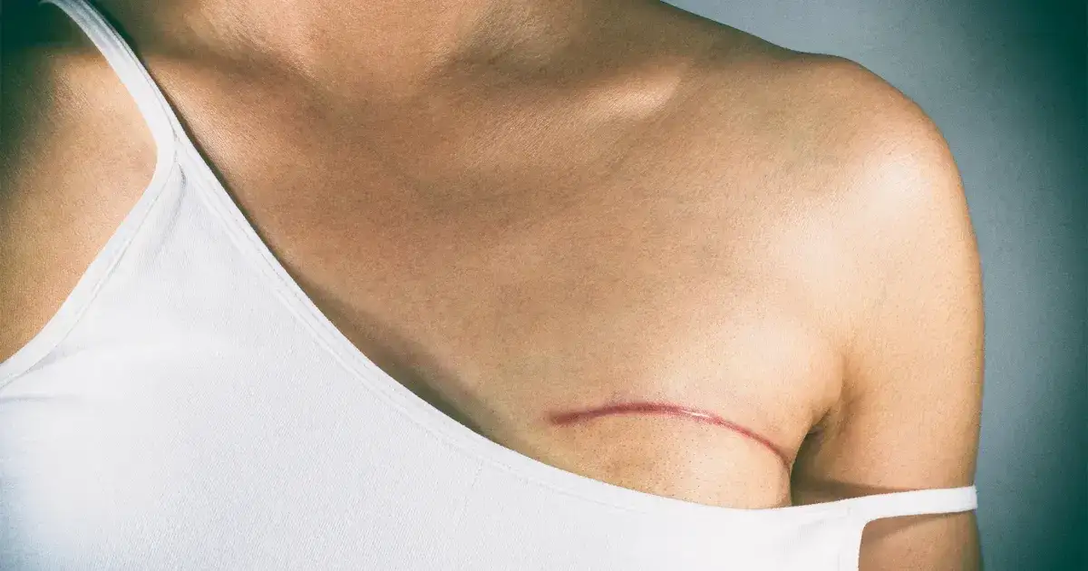 Mastektomia z rekonstrukcją nfz gdzie? Sprawdź dostępne ośrodki w Polsce