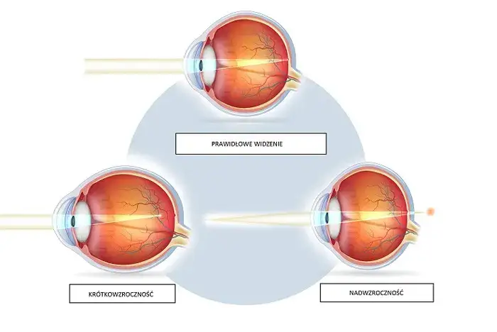 Jak wyleczyć wadę wzroku minus? Skuteczne metody poprawy widzenia