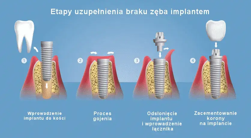 Jak wygląda implant zęba? Wszystko o budowie i procesie wszczepiania
