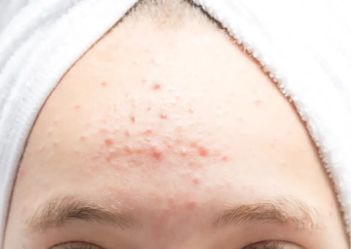 Łojotok – co to za zjawisko, objawy i jak skutecznie leczyć?