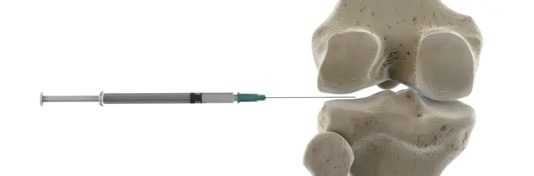 Czy zastrzyki z kwasu hialuronowego są refundowane przez NFZ?