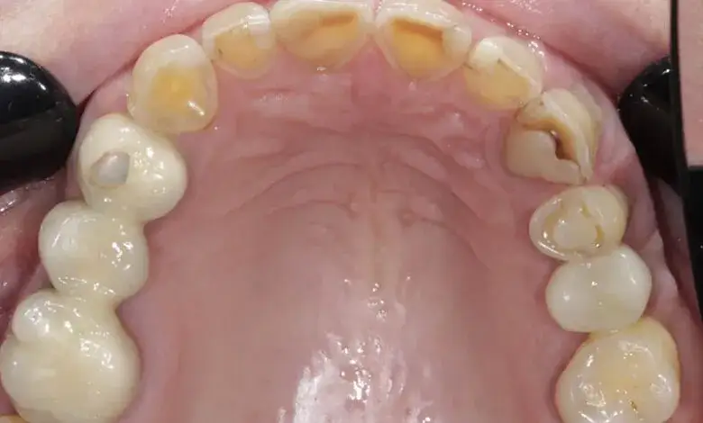 Jak bezpiecznie zatkać dziurę w zębie? Tymczasowe sposoby na ulgę przed dentystą