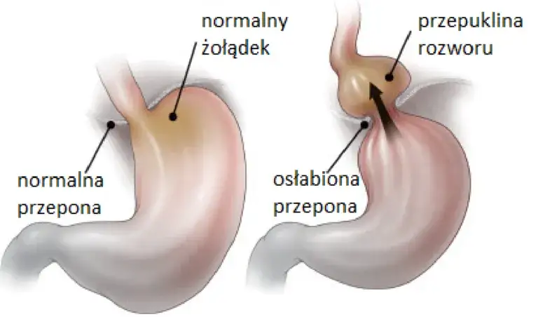 Przepuklina jaki lekarz - kogo wybrać, aby uniknąć problemów zdrowotnych