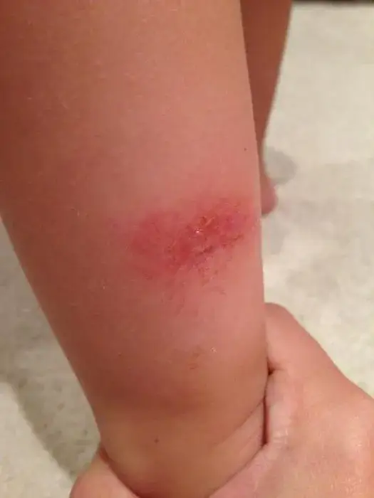 Ukąszenia komarów u dzieci: skuteczne sposoby na uciążliwe krosty i swędzenie