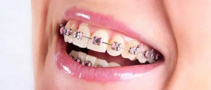 Czy aparat na zęby naprawdę zmienia kształt twarzy? Sprawdź, jak wpływa na rysy