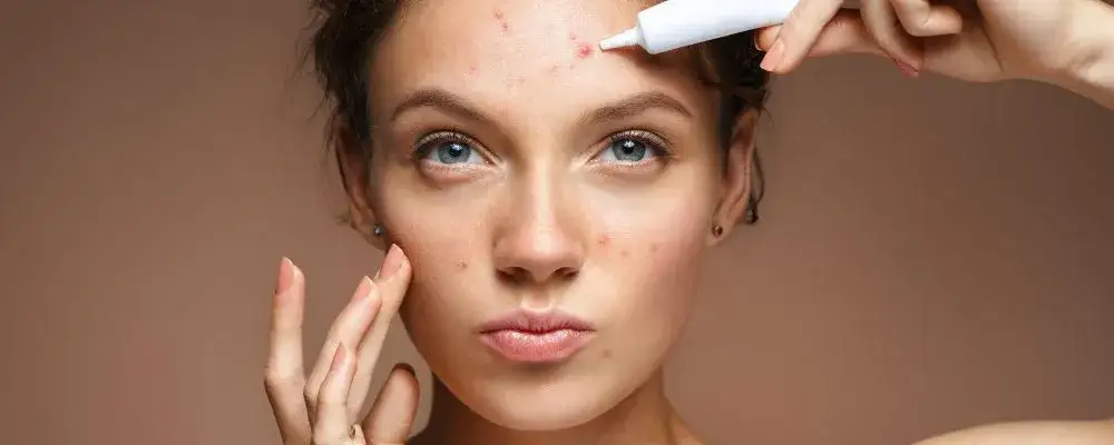 Jakie kosmetyki na trądzik naprawdę działają i przynoszą ulgę?