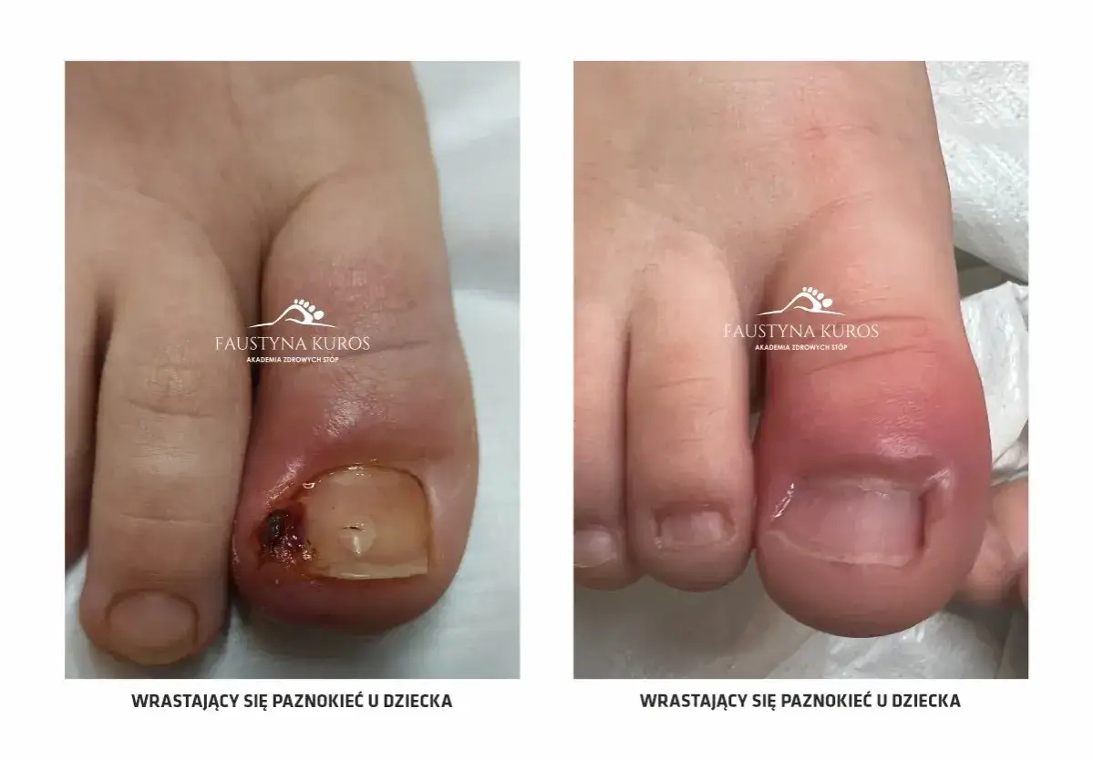 Wrastający paznokieć: Jak rozpoznać objawy i kiedy do podologa?