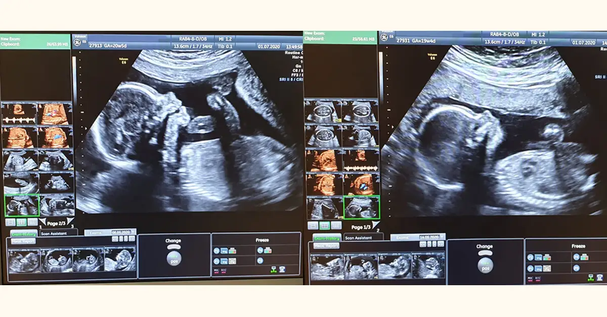 Badania prenatalne w 12 tyg. ciąży: USG genetyczne i PAPP-A bez obaw