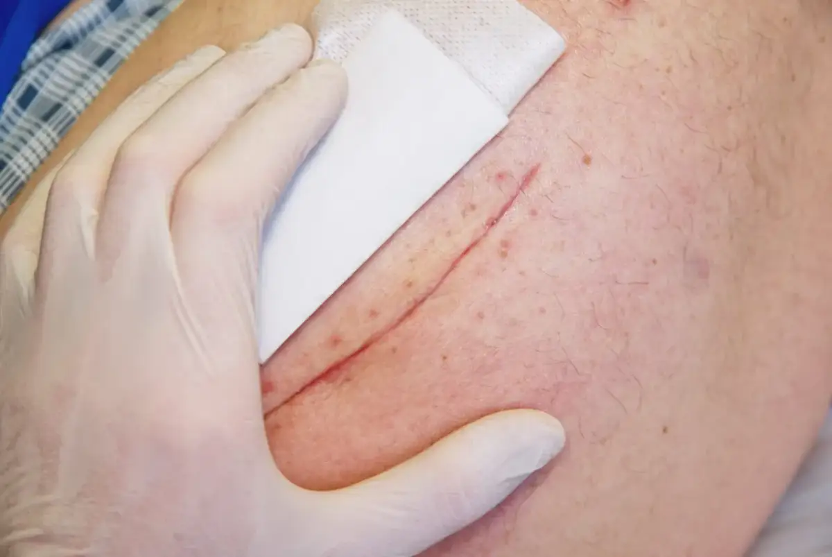 Jak uniknąć zrostów po operacji - sprawdzone sposoby na zdrowie