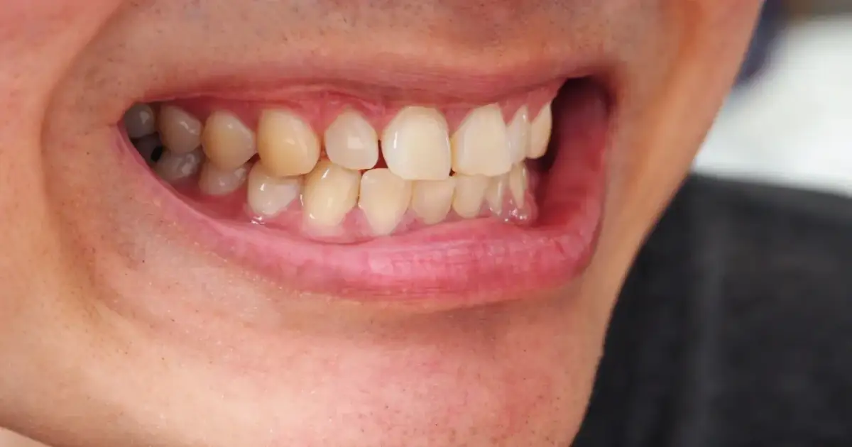 Olej kokosowy na zęby: wybielanie czy zdrowszy uśmiech? Ekspert radzi