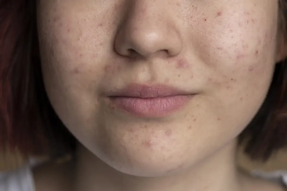 Niedobór witaminy A objawy skórne – jak uniknąć problemów ze skórą