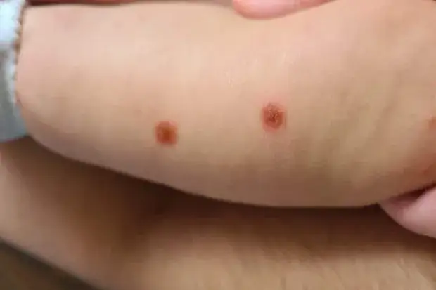 Czy po bostonce schodzą paznokcie? Objawy i co warto wiedzieć