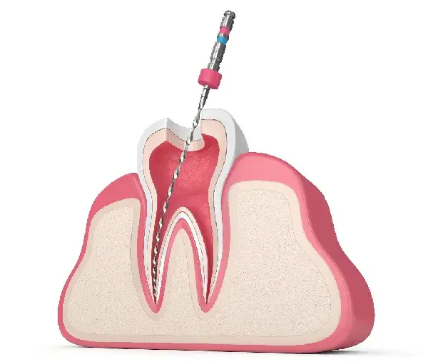 Ból zęba? Sprawdź, czy to leczenie kanałowe i kiedy do dentysty