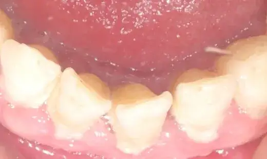 Ile kosztuje usunięcie kamienia nazębnego? Ceny, NFZ, pełna higienizacja.