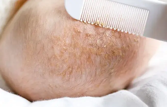 Jak postępować z ciemieniuchą u niemowlaka, aby uniknąć problemów