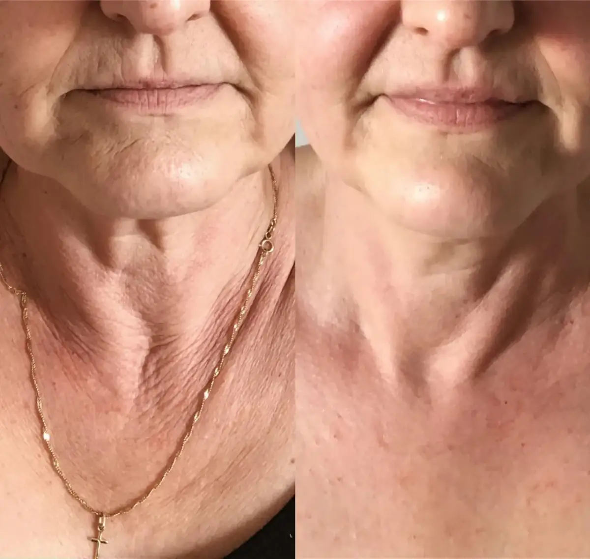 Masaż Kobido: Ile trwa zabieg i jak długo trwają efekty?