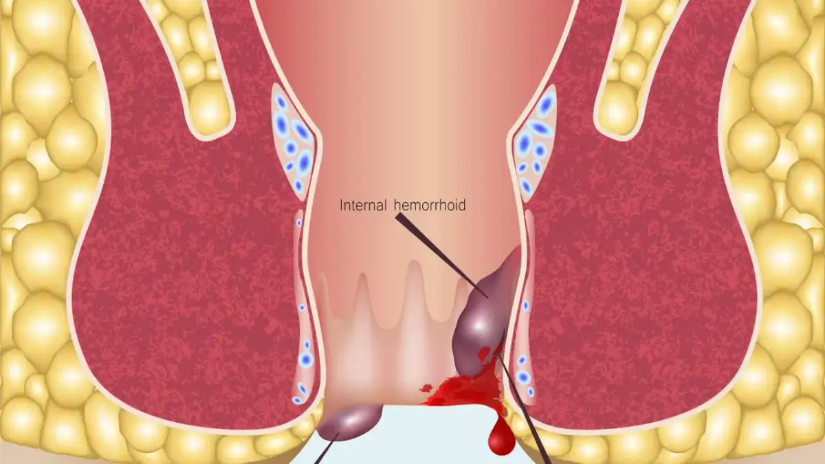 Ilustracja anatomiczna hemoroidów wewnętrznych z krwawieniem.