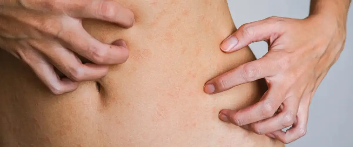 Zaburzenia hormonalne objawy skórne: co może oznaczać Twoja skóra?