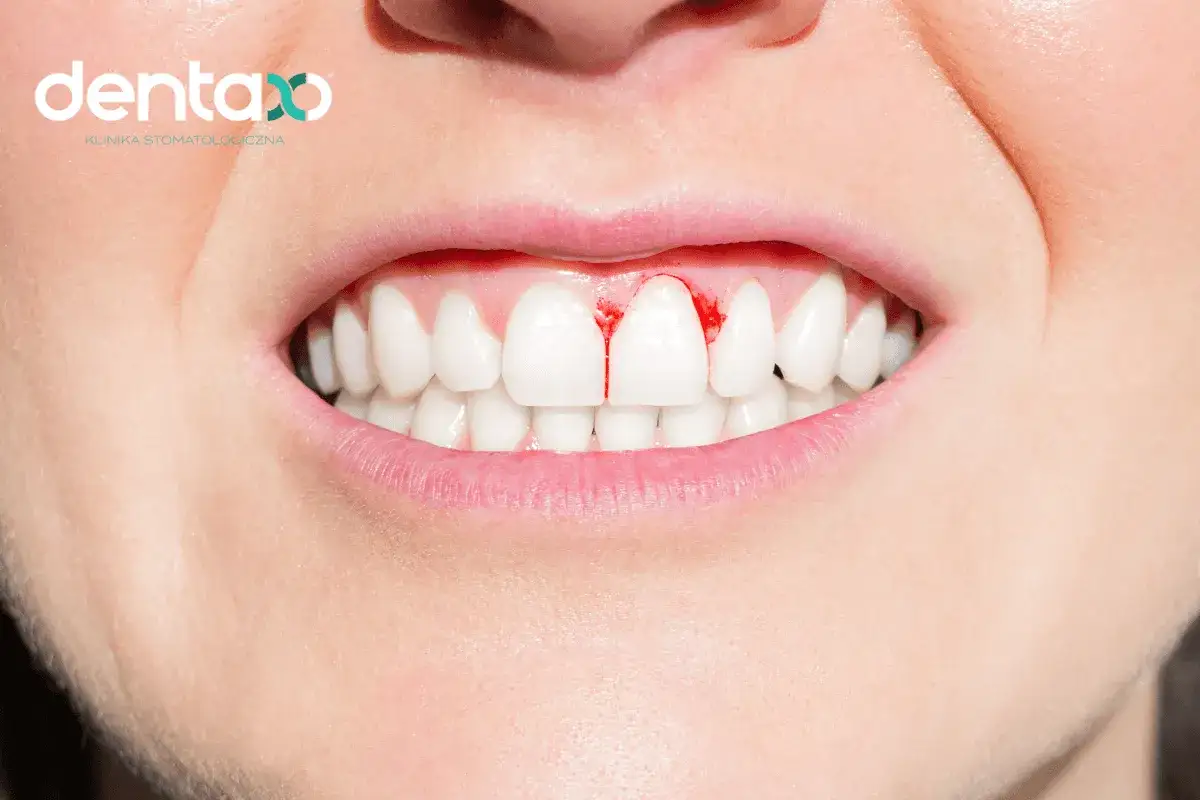 Krwawiące dziąsła? Odkryj 10 przyczyn i skuteczne sposoby leczenia!