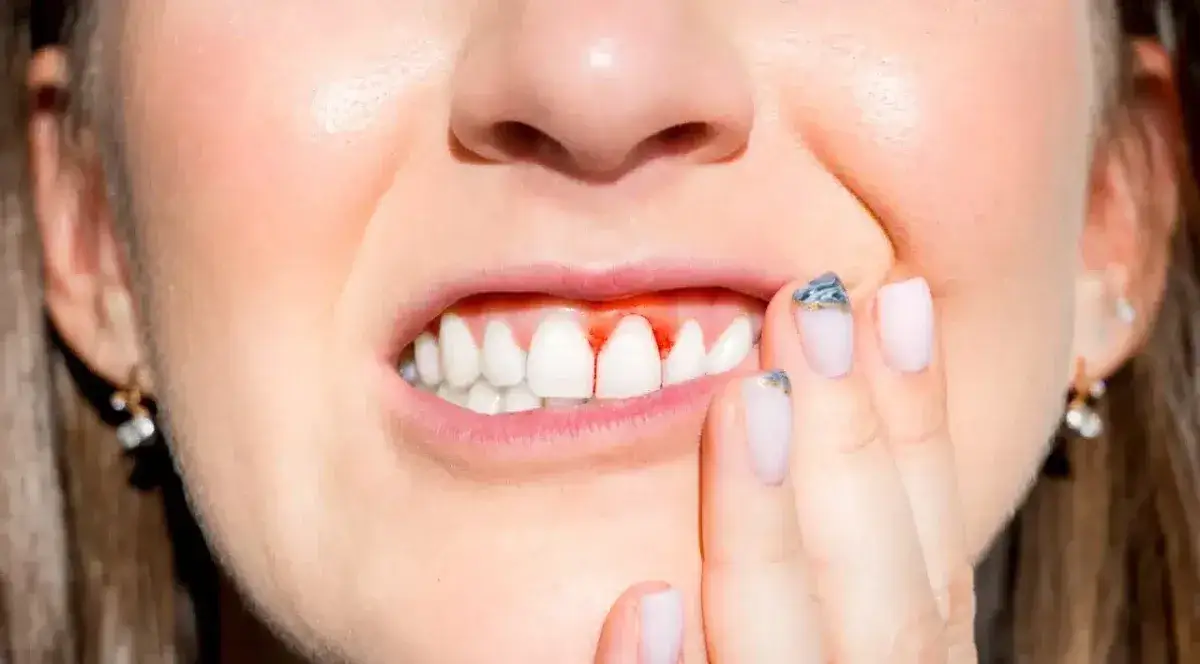 Krwawiące dziąsła? Zatamuj krwotok w 3 krokach i poznaj przyczyny