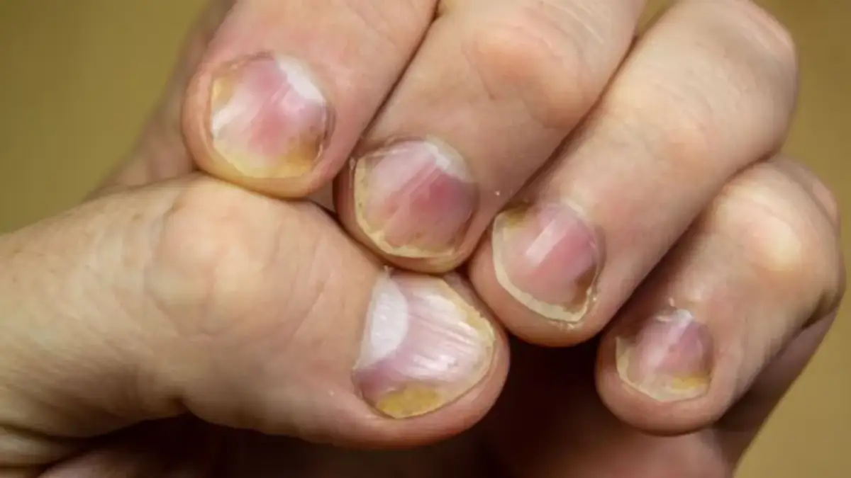 Paznokcie a zdrowie: Co mówią o Tobie? Sprawdź objawy i sygnały!