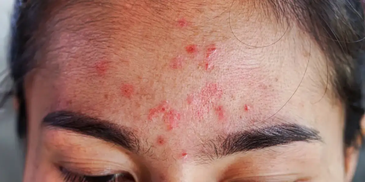 Pryszcze na czole: Zwalcz przyczyny i odzyskaj gładką cerę!