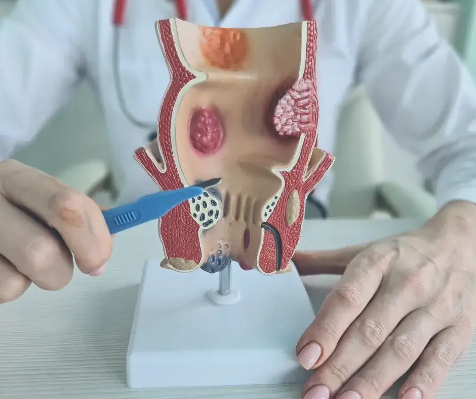 Do jakiego lekarza z hemoroidami? Sprawdź ścieżkę leczenia