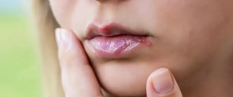 Pęcherze w ustach: Skuteczne leczenie, domowe triki i kiedy do lekarza
