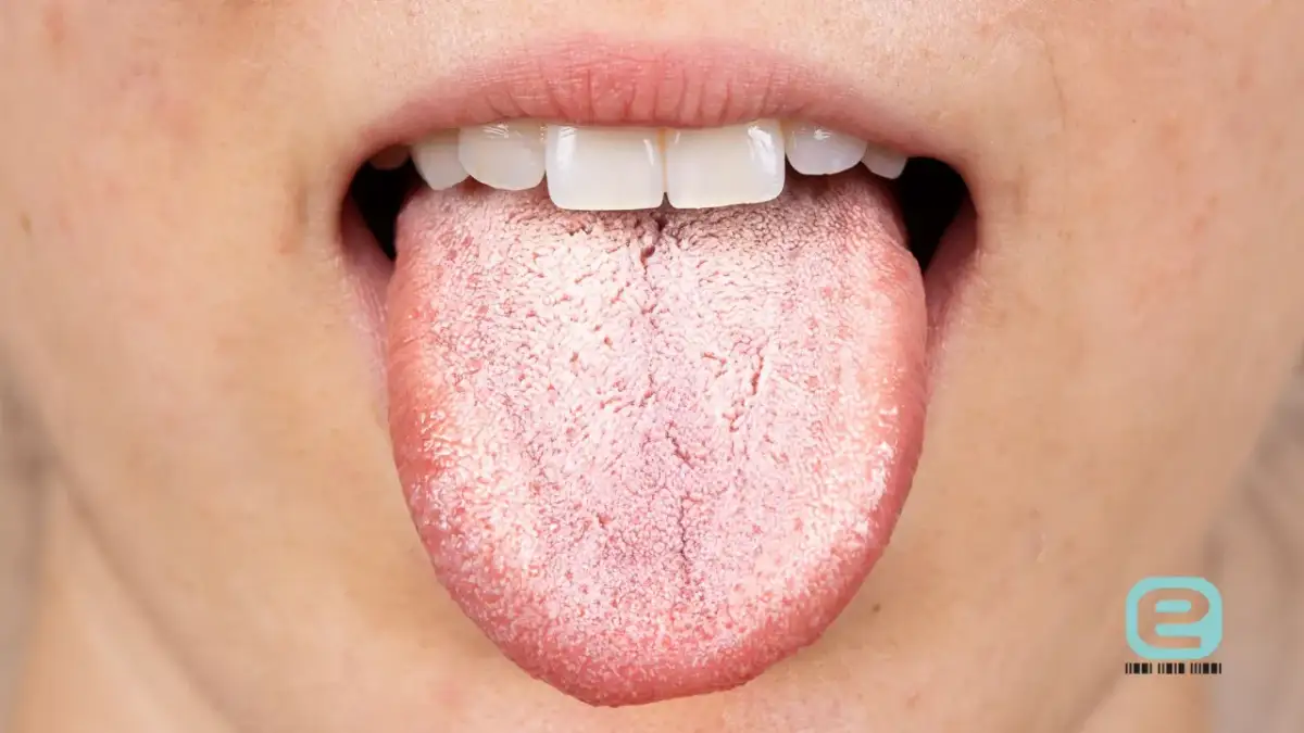 Grzybica jamy ustnej: objawy, przyczyny i kiedy do lekarza?