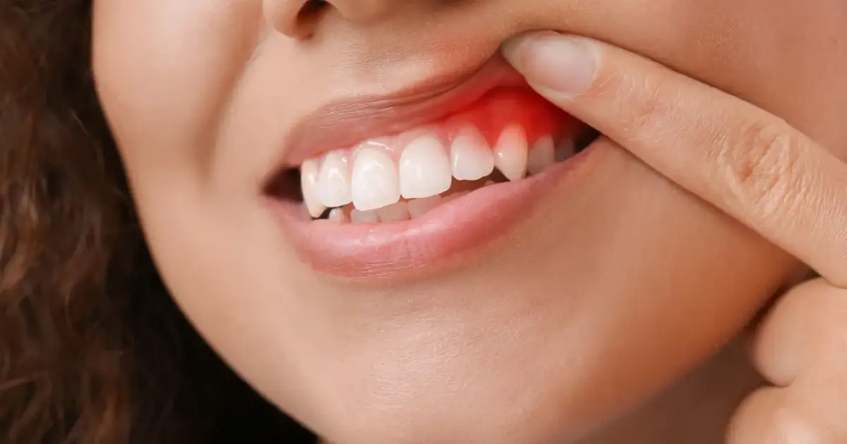 Krwawienie dziąseł: sygnał, którego nie możesz ignorować. Co robić?