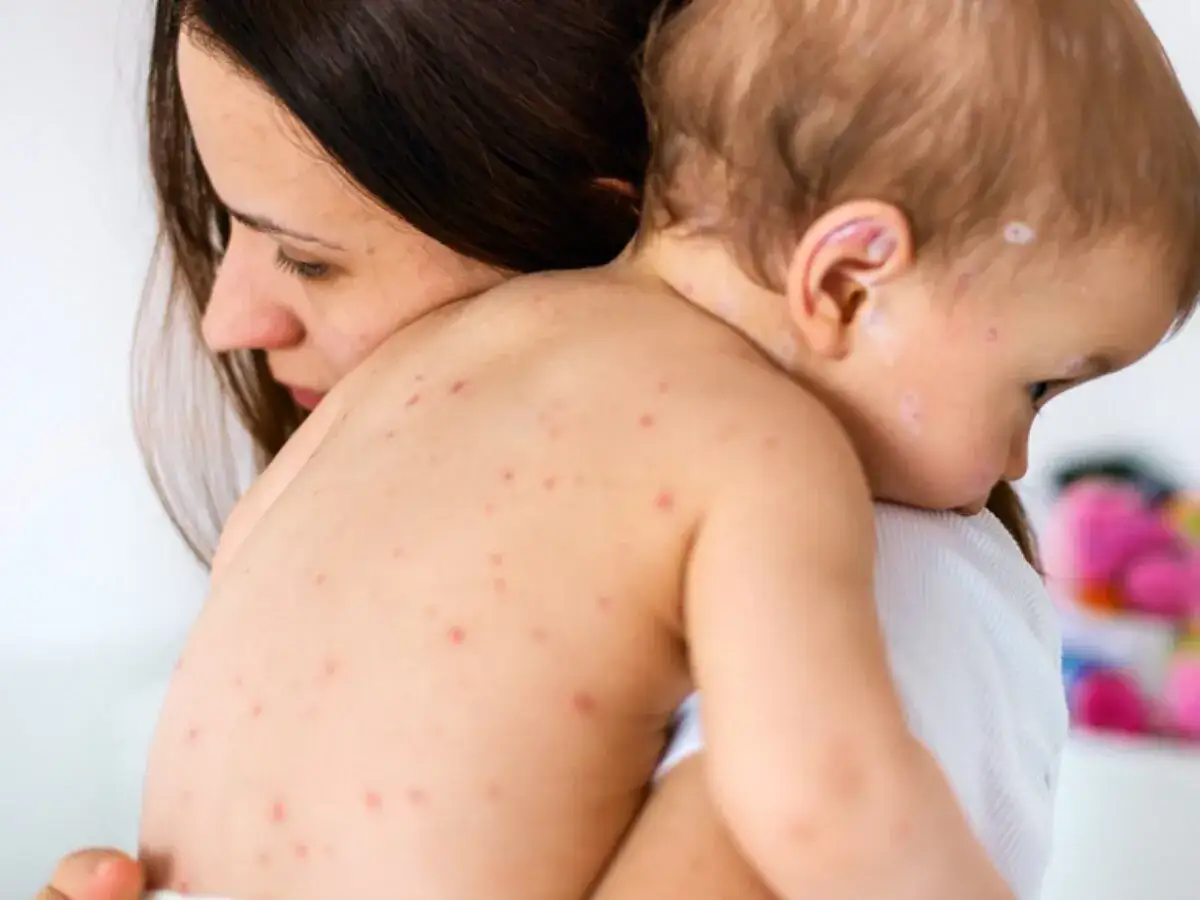 W czym kąpać dziecko z ospą? Sprawdzone sposoby na ulgę