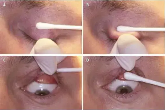 Jak okulista wyciąga coś z oka - bezpieczne metody usuwania ciał obcych