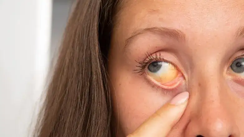 Zespół Gilberta a psychika: Czy bilirubina wpływa na Twój nastrój?