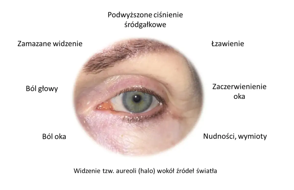 Zbliżenie na ludzkie oko z zaznaczonymi objawami jaskry: ból oka, zamglone widzenie, łzawienie.