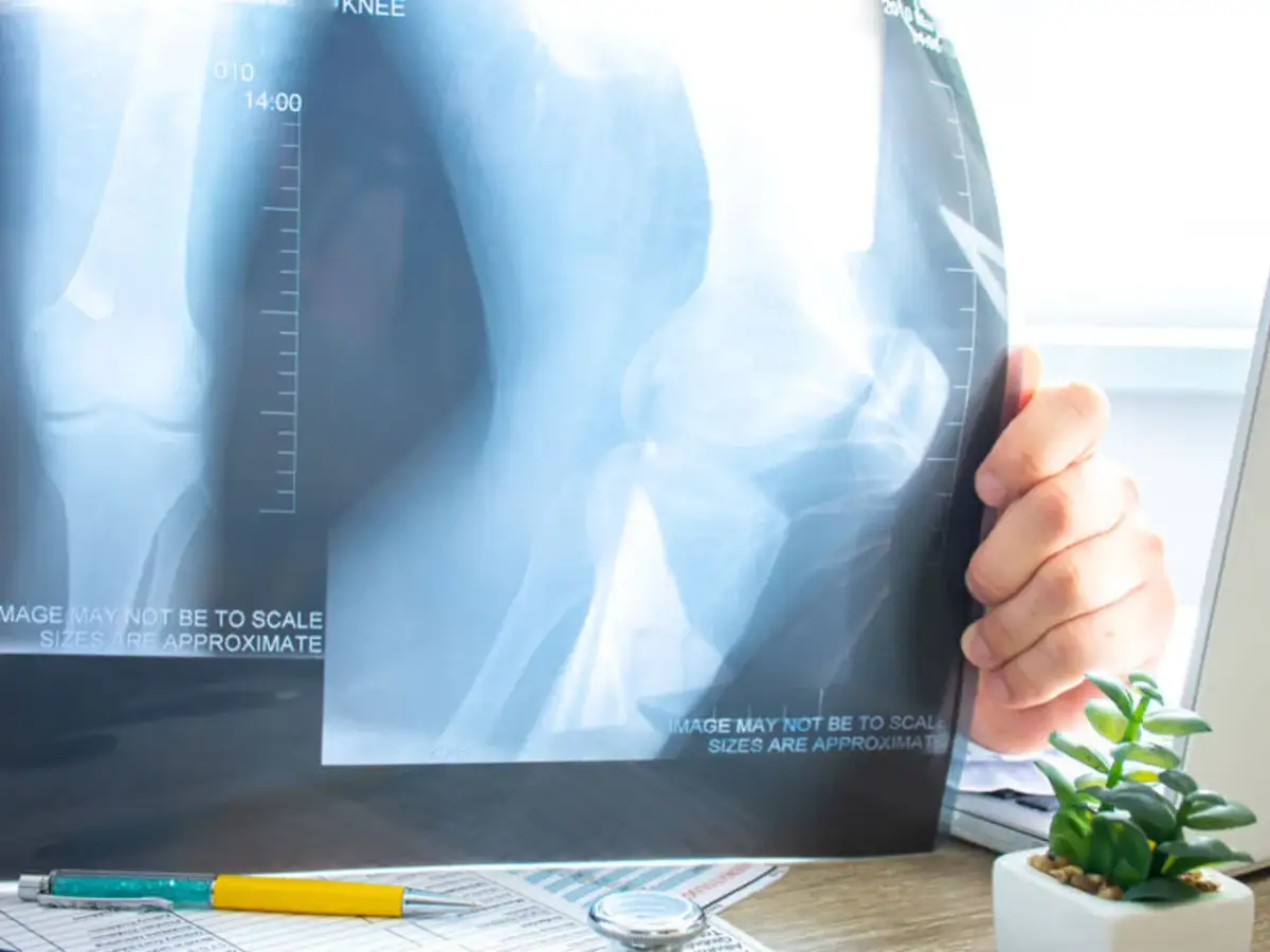 Rehabilitacja po zwichnięciu rzepki: Ile trwa i co Cię czeka?