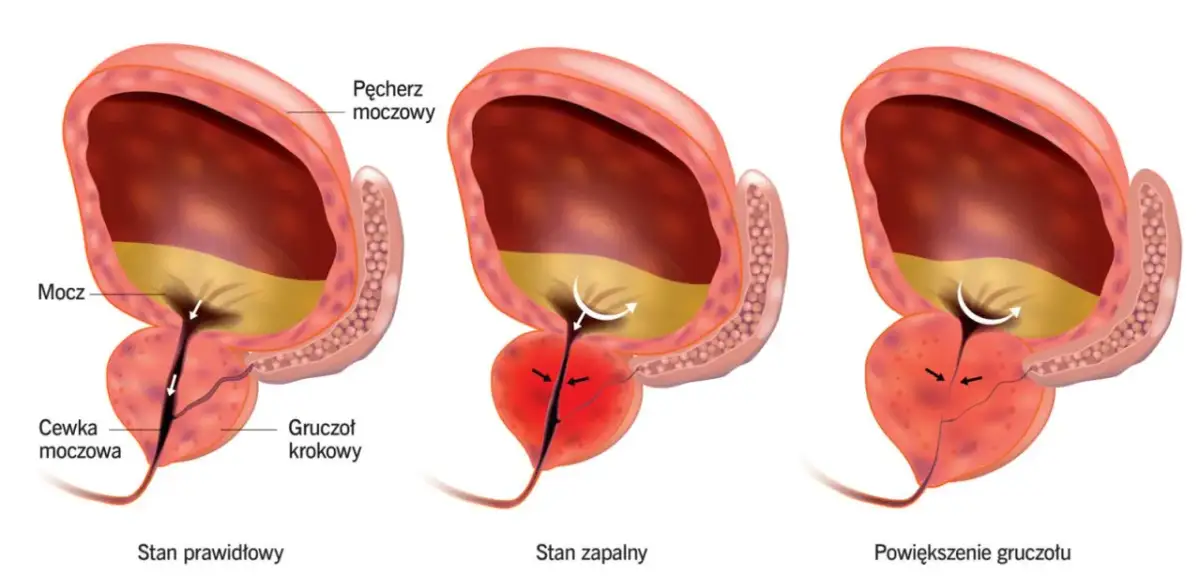 Prostata w jakim wieku powinieneś zacząć badania, aby uniknąć ryzyka