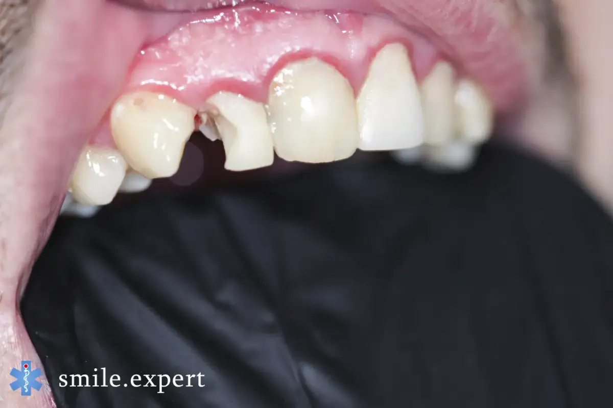 Ukruszona jedynka? Ile kosztuje odbudowa? Porównaj metody i ceny