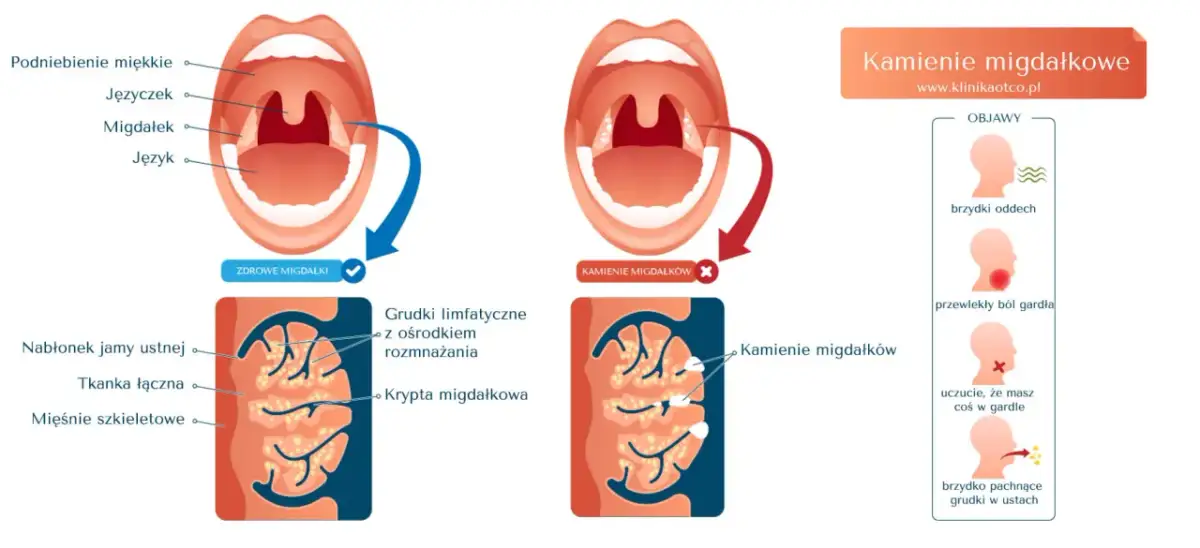 Ilustracja pokazuje zdrowe migdałki i migdałki z kamieniami. Kamienie migdałkowe mogą powodować brzydki oddech i ból gardła.
