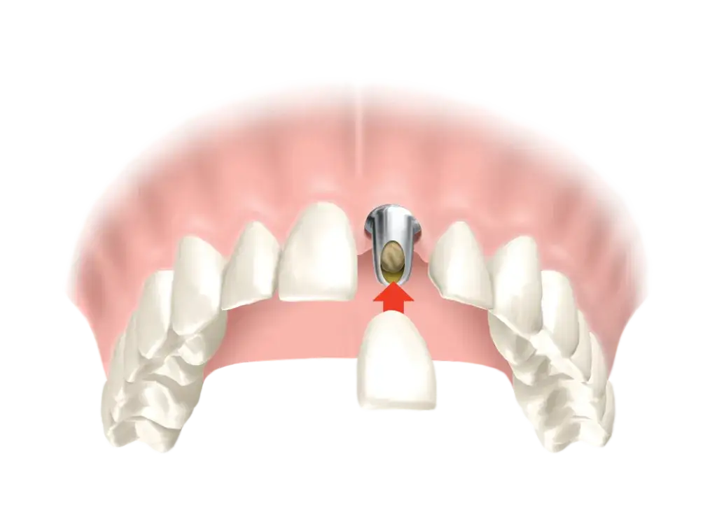 Korony zębowe: Jak wyglądają, kiedy są potrzebne i jak przebiega zakładanie?