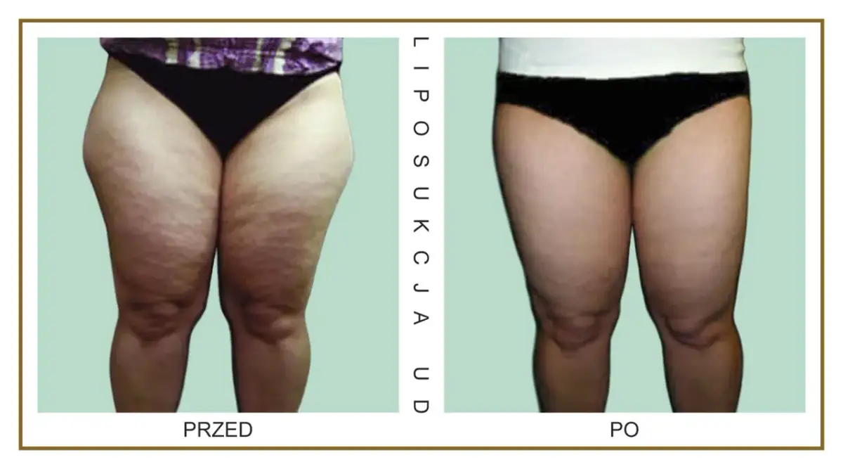 Liposukcja ud: Ile kosztuje i od czego zależy cena?
