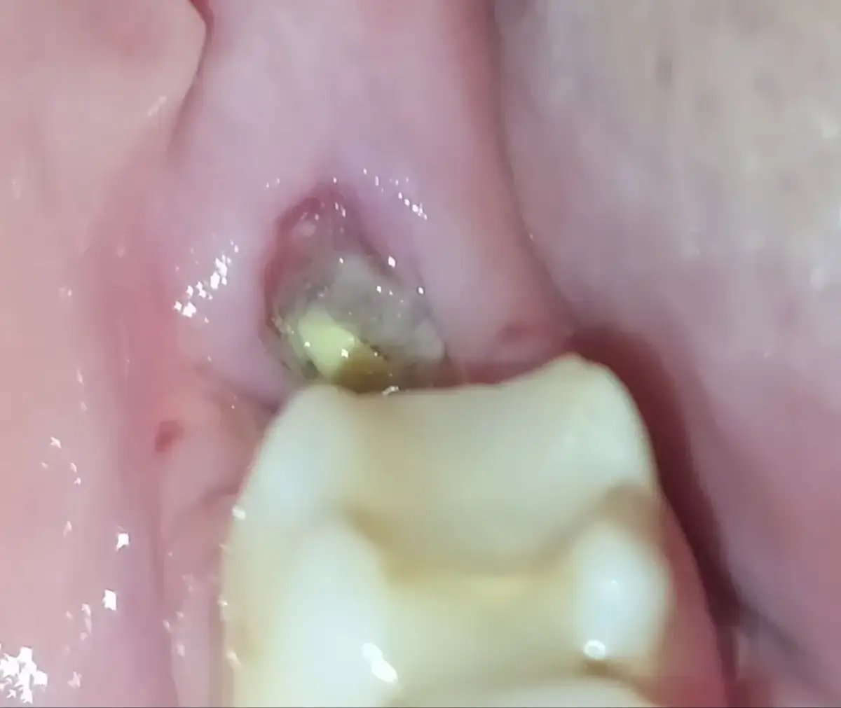 Jak goi się dziąsło po wyrwaniu zęba? Co musisz wiedzieć o bólu i komplikacjach