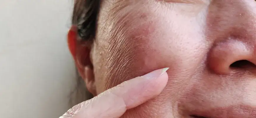 Skutki uboczne radioterapii: Co musisz wiedzieć przed leczeniem