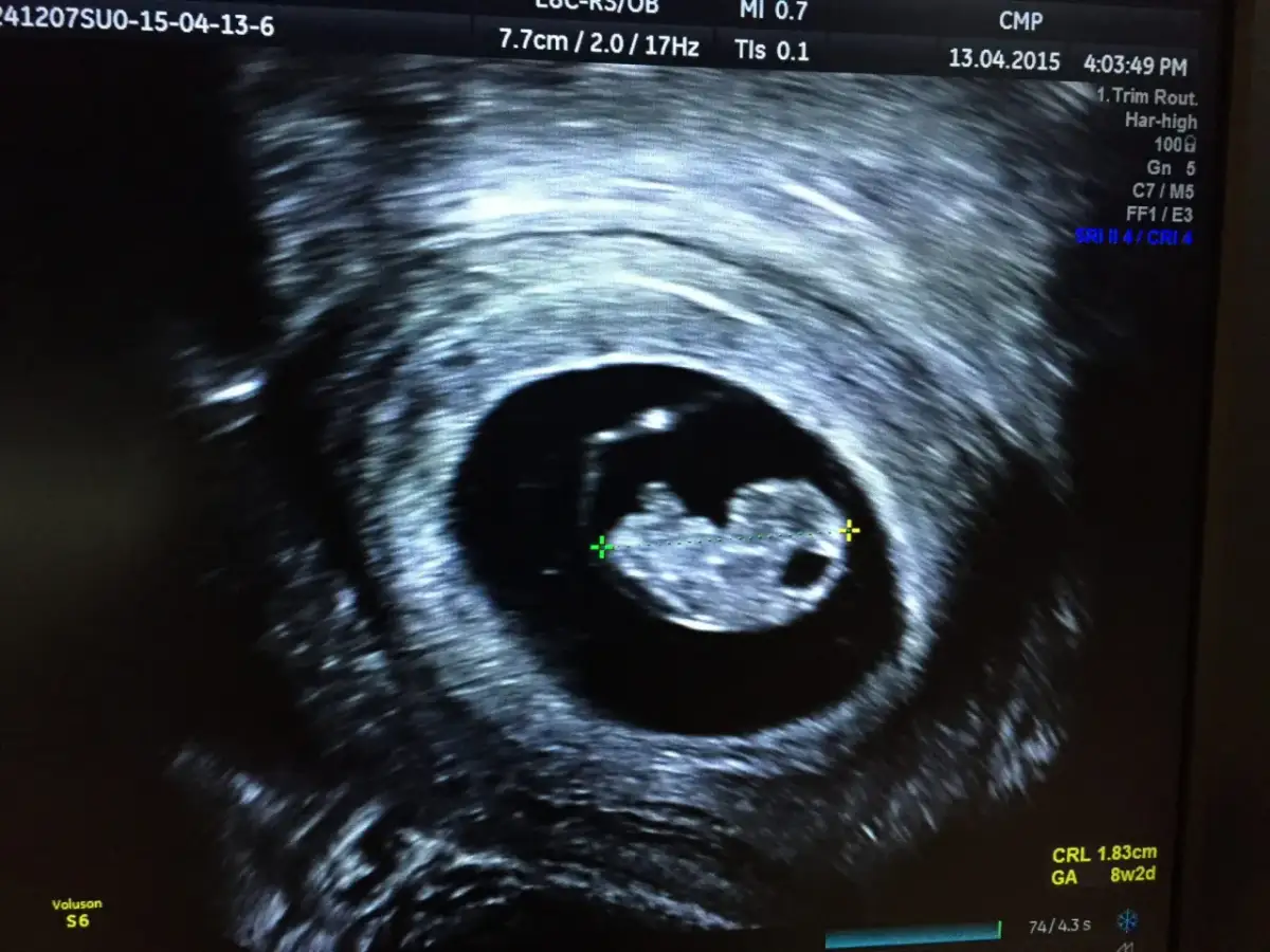 Kiedy USG dopochwowe potwierdzi ciążę? Tydzień po tygodniu